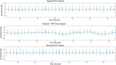 Enhancement of single-lead dry-electrode ECG through wavelet denoising